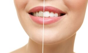 Read more about the article Teeth Whitening: How Does It Work?