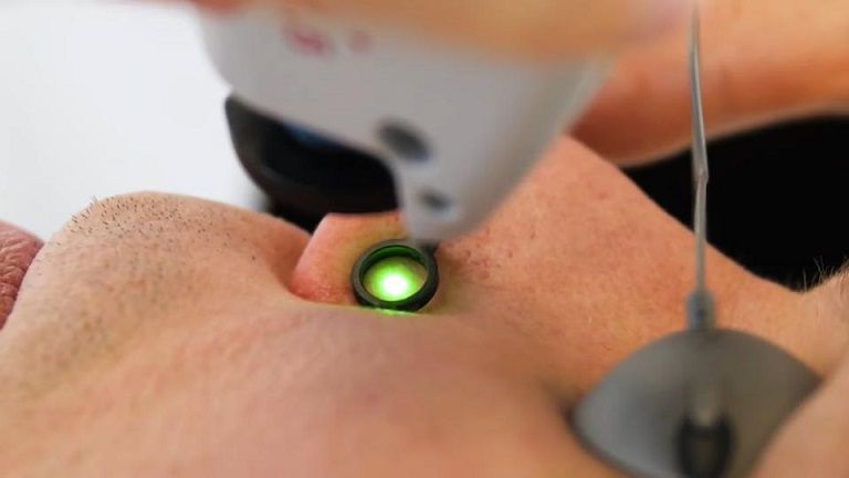Read more about the article Laser Vein Removal