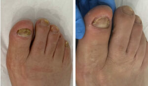 Read more about the article Laser Toenail Fungus Removal: What It Is and How It Works