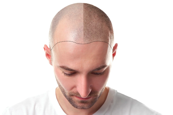 Read more about the article What is Scalp Micropigmentation?