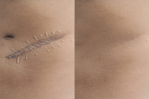 Read more about the article Laser Scar Removal: Post Treatment Care