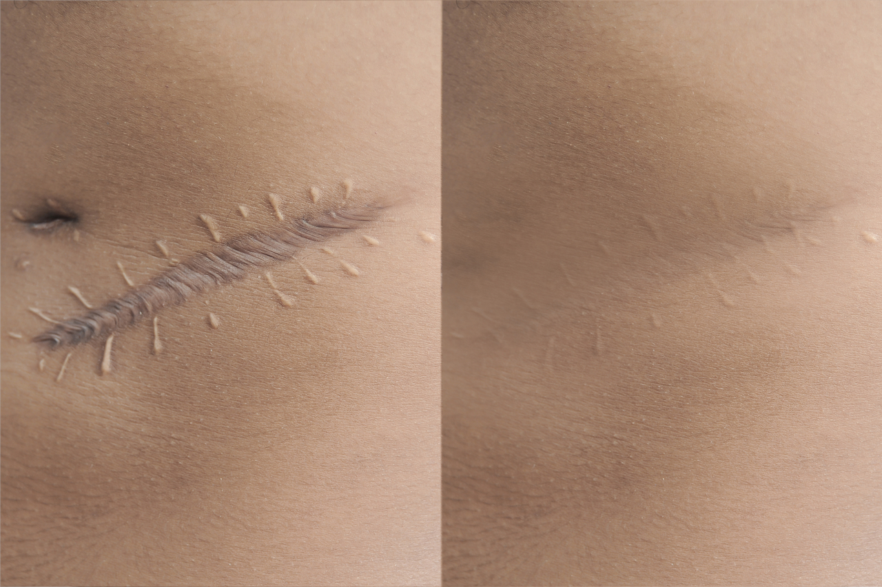 Read more about the article Laser Scar Removal: Post Treatment Care