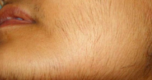 Read more about the article Signs of hormonal Imbalances (Hirsutism)