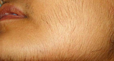 Read more about the article Signs of hormonal Imbalances (Hirsutism)