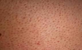 Read more about the article Keratosis Pilaris